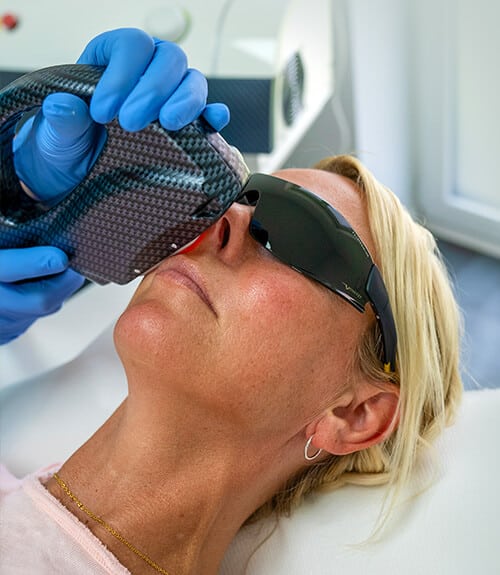 IPL-behandling i ansigtet med beskyttelsesbriller